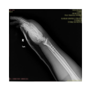Distal radius kırığı-Elbileği kırığı.