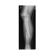 Çocuk tibia kırığı