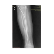 Titanyum Elastik çivi (TEN) ile çocuk tibia kırığı tedevisi.