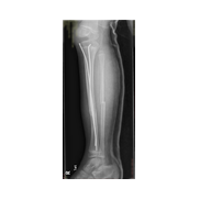 Titanyum Elastik çivi (TEN) ile çocuk tibia kırığı tedevisi.