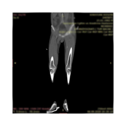 Femur kondil kırığı.