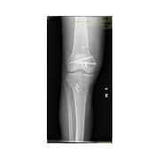 Femur kondil kırığı.