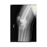 Femur kondil kırığı.