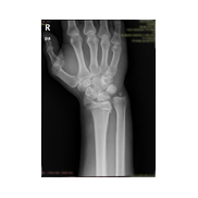 Distal radius kırığı-Elbileği kırığı.