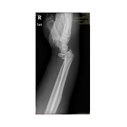 Distal radius kırığı-Elbileği kırığı.