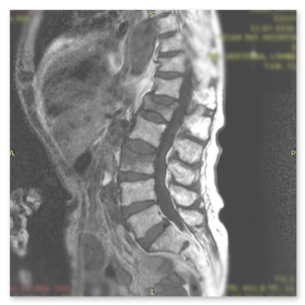 Osteoporotik Omurga Kırığı Lomber 3 Ameliyat Görüntüleri