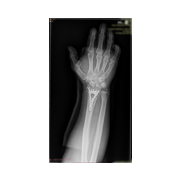 Distal radius kırığı-Elbileği kırığı.