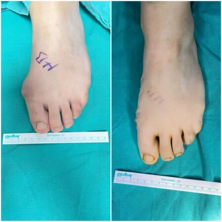 Halluks Valgus / Ayak Eğriliği