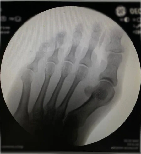 X-Ray Halluks Valgus