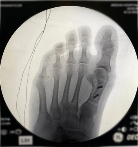 Halluks Valgus X-Ray