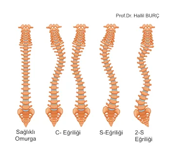 Skolyoz ve Farklı omurga bilgileri