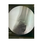 Topuk Kırığı, kalkaneus kırığı.