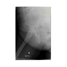 Kalça Protezi ve Ameliyat Sonrası Bilgisi