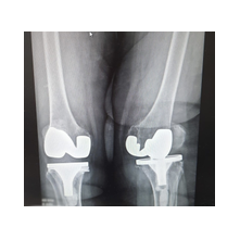 Diz Protezi ve Ameliyat Sonrası Bilgisi