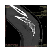 Radius başı kırığı.