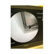 Radius başı kırığı. Dirsek Kırığı. Radius başı protezi.