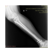 Tibia intrameduller çivileme