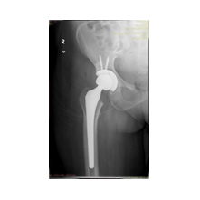 Kalça Protezi ve Ameliyat Sonrası Bilgisi