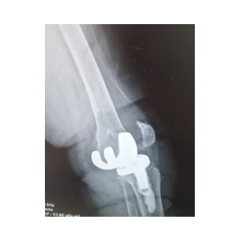 Diz Protezi ve Ameliyat Sonrası Bilgisi