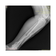 Tibia Kırığı Plak vida ile Minimal Osteosentez.