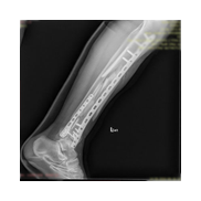 Tibia Kırığı Plak vida ile Minimal Osteosentez.