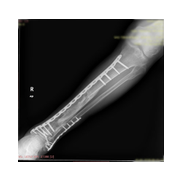 Tibia Kırığı Plak vida ile Minimal Osteosentez.