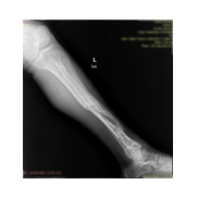 Tibia Kırığı Plak vida ile Minimal Osteosentez.