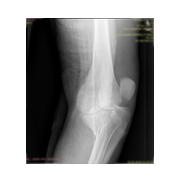 Tibia Plato Kırığı plak vida ile osteosentez.