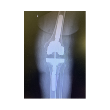 Diz Protezi ve Ameliyat Sonrası Bilgisi