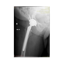 Kalça Protezi ve Ameliyat Sonrası Bilgisi