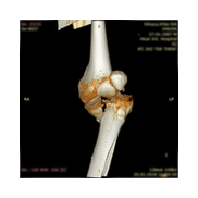 Tibia Plato Kırığı plak vida ile osteosentez.
