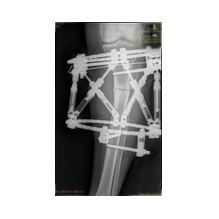 Boy Uzatma ve Deformite Düzeltme: Yeni Bir Başlangıç İçin Doğru Adım