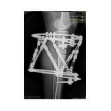 Boy Uzatma ve Deformite Düzeltme: Yeni Bir Başlangıç İçin Doğru Adım