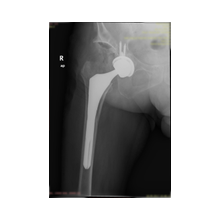 Kalça Protezi ve Ameliyat Sonrası Bilgisi