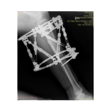 Boy Uzatma ve Deformite Düzeltme: Yeni Bir Başlangıç İçin Doğru Adım