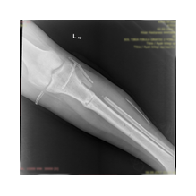 Boy Uzatma ve Deformite Düzeltme: Yeni Bir Başlangıç İçin Doğru Adım