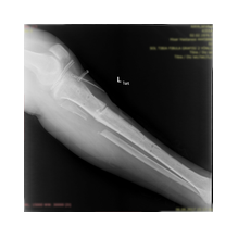 Boy Uzatma ve Deformite Düzeltme: Yeni Bir Başlangıç İçin Doğru Adım